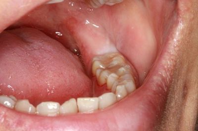 Đừng bỏ lỡ 4 cách chữa sâu răng dân gian cực hiệu quả