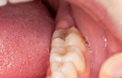 Áp xe nướu răng là gì? Điều trị như thế nào?