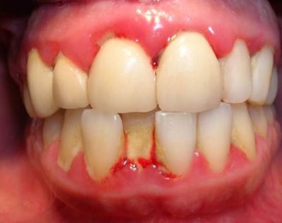 Giải đáp thắc mắc: Chảy máu chân răng là thiếu chất gì? Có nguy hiểm không? XEM NGAY