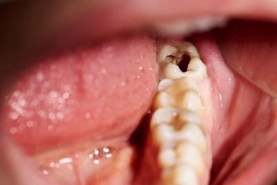 4 mẹo hay chữa sâu răng tại nhà bạn nên biết!