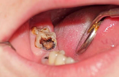 Viêm tủy răng cấp tính nên điều trị như thế nào? TÌM HIỂU NGAY