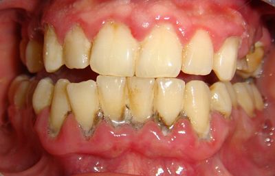 Viêm chân răng là gì? Cách khắc phục tại nhà như thế nào? TÌM HIỂU NGAY