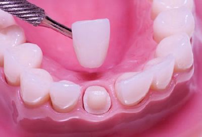 Bọc răng sứ bị hôi miệng phải làm sao? XEM NGAY