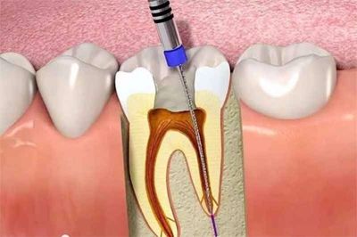 Phải làm sao khi bị viêm tủy răng có mủ? XEM TẠI ĐÂY