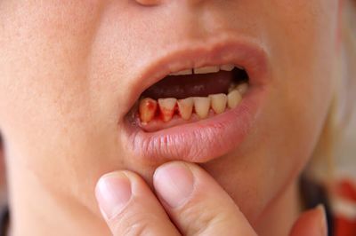 Tìm hiểu ngay cách chữa chảy máu chân răng hiệu quả hiện nay!
