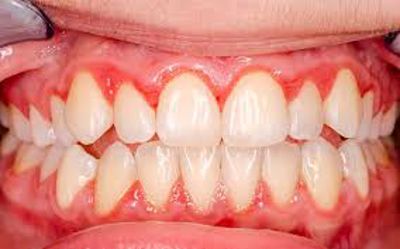 Tại sao bị viêm chân răng và làm cách nào để cải thiện? THAM KHẢO NGAY