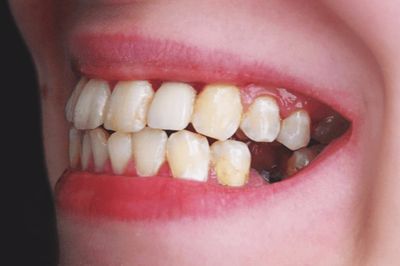 Viêm chân răng là gì? Dùng thảo dược có cải thiện được không?