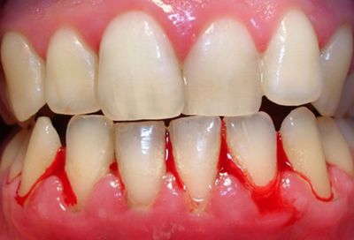 Bạn có thể tự chữa chảy máu chân răng tại nhà nhờ 4 cách ĐƠN GIẢN!