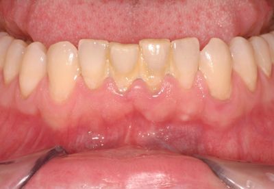 Bệnh viêm nha chu: Coi chừng mất răng sớm!
