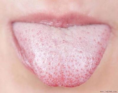 Giải đáp: Lưỡi trắng gây hôi miệng - Nguyên nhân do đâu và cách khắc phục?