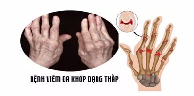 Các giai đoạn phát triển của bệnh viêm khớp dạng thấp