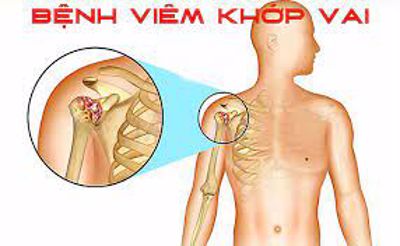 VIÊM QUANH KHỚP VAI chữa thế nào? 