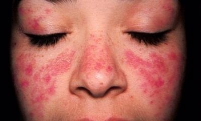 Bệnh lupus ban đỏ có nguy hiểm không? Một số lưu ý trong điều trị lupus ban đỏ là gì?