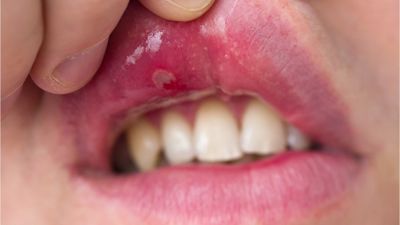 Làm thế nào để bệnh lupus không ảnh hưởng đến miệng?