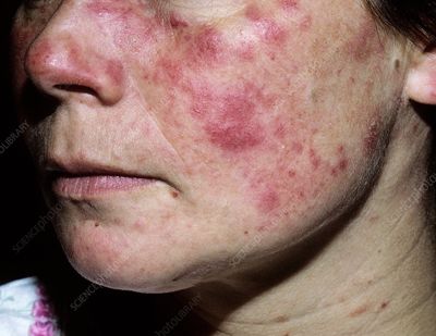 Bệnh lupus ban đỏ biến chứng thận nguy hiểm ra sao? Đọc ngay!