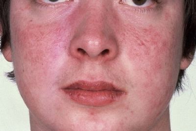 10 triệu chứng lupus ban đỏ ban đầu là gì? Tìm hiểu ngay!