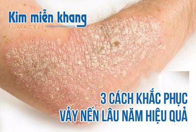 Nguyên nhân và hướng điều trị vẩy nến thế giọt là gì?