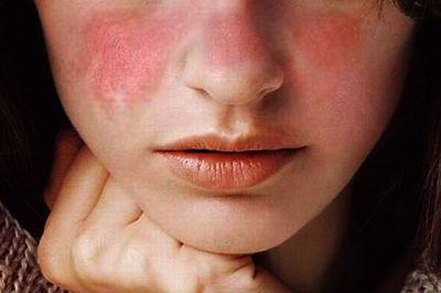 Dấu hiệu lupus ban đỏ - Biết sớm để điều trị bệnh hiệu quả