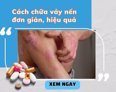 Cách chữa vảy nến đơn giản, hiệu quả mà không phải ai cũng biết