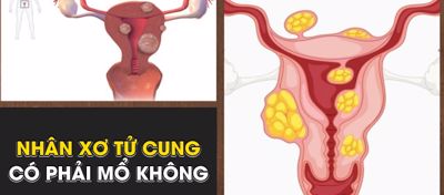 Nhân xơ tử cung có phải mổ không? Cách trị bệnh hiệu quả là gì?