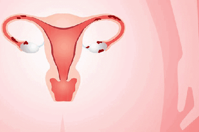 Trong thời gian điều trị u lạc nội mạc tử cung mà mang thai thì có bị ảnh hưởng gì không?