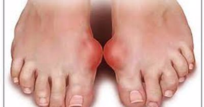 Cơn gút cấp thường khởi phát ở ngón chân cái
