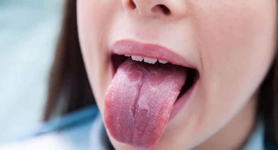 Nguyên nhân nào gây ung thư lưỡi? Ung thư lưỡi có chết không?