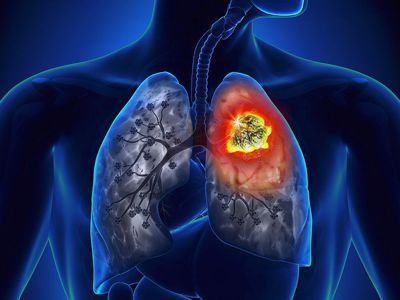 GIẢI ĐÁP: Nguyên nhân ung thư phổi là gì?