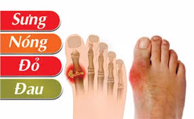 Sưng, nóng, đỏ ngón chân cái - bệnh gì?