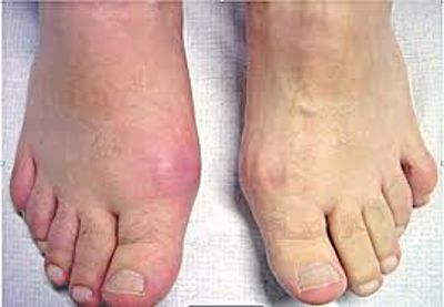Những dấu hiệu bệnh gút ở chân và cách cải thiện hiệu quả từ thảo dược