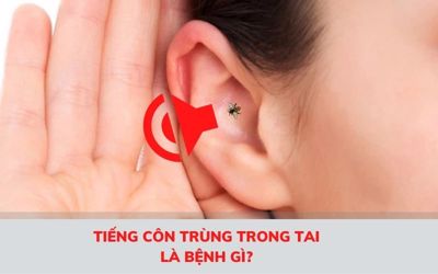 Nghe thấy tiếng côn trùng trong tai là triệu chứng của bệnh gì?