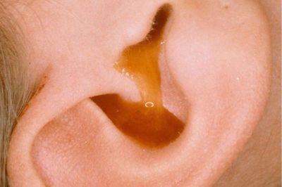 Viêm tai giữa ứ dịch có thể gây điếc 