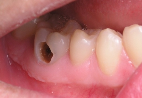 5 hậu quả tiêu biểu của bệnh mất răng sớm?