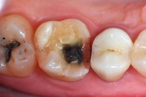 Mất răng gây nguy hiểm như thế nào với người cao tuổi?