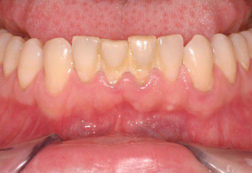 “Menu” triệu chứng viêm quanh răng gồm những gì?