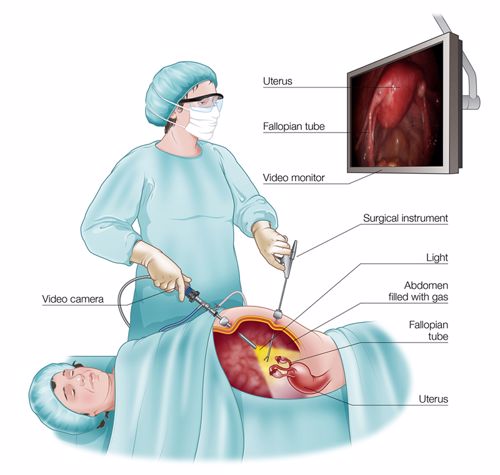 Khi nào cần điều trị phẫu thuật u lạc nội mạc tử cung?