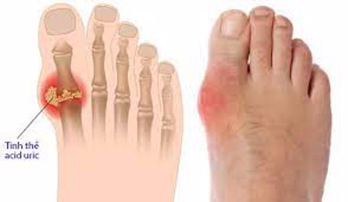 Khớp ngón chân cái sưng đau vì bị bệnh gút, phải làm sao để cải thiện?