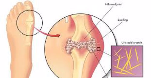 Điều trị gút và những vấn đề cần chú ý