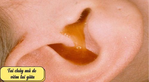 Viêm tai giữa tiết dịch, bệnh thường gặp ở trẻ em