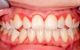  6 cách kiểm soát cao răng giúp ngăn ngừa viêm lợi