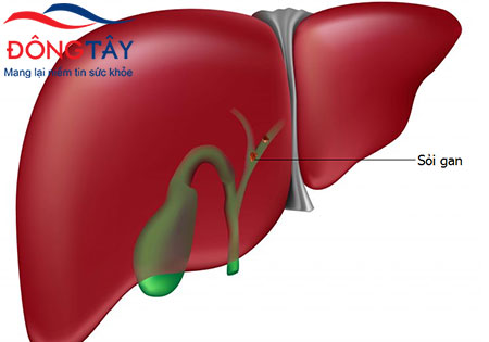 Bệnh sỏi gan có triệu chứng gì?
