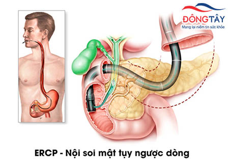 Phuong-phap-noi-soi-mat-tuy-nguoc-dong-ERCP