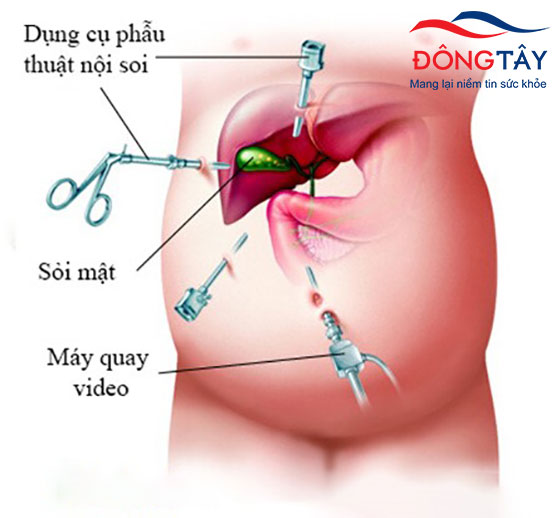Phẫu thuật cắt túi mật nội soi là chỉ định phổ biến khi sỏi mật gây biến chứng