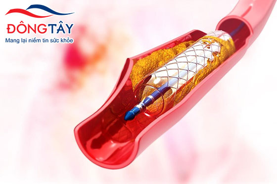 Không phải khi nào đặt stent cũng là cách điều trị xơ vữa mạch vành hiệu quả nhất.