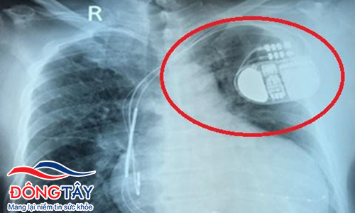 Hình ảnh máy tạo nhịp tim cũ nặng 28 gam, nằm cồng kềnh trên ngực trái