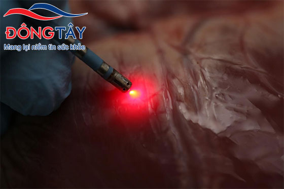 Phương pháp quang phổ cận hồng ngoại làm tăng hiệu quả điều trị của phương pháp cắt đốt điện sinh lý bằng sóng Radio