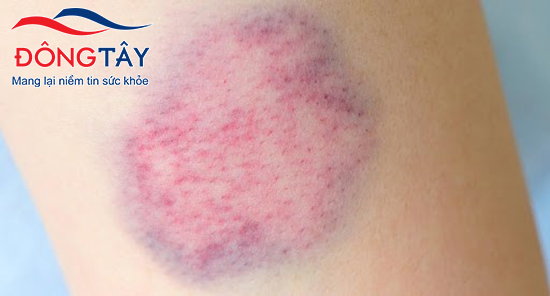   Vết bầm tím dưới da bất thường cảnh báo nguy cơ xuất huyết khi dùng Apixaban