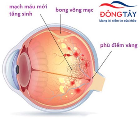 Hình ảnh mắt bị tổn thương do biến chứng mắt của bệnh tiểu đường