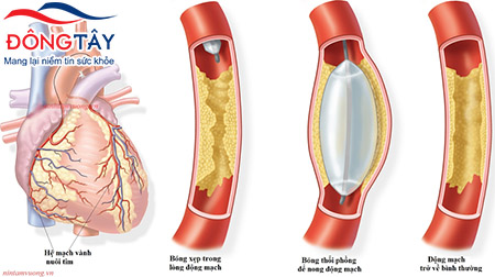 Kỹ thuật nong mạch vành cấp