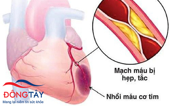 Nhồi máu cơ tim là biến chứng của xơ vữa động mạch vành